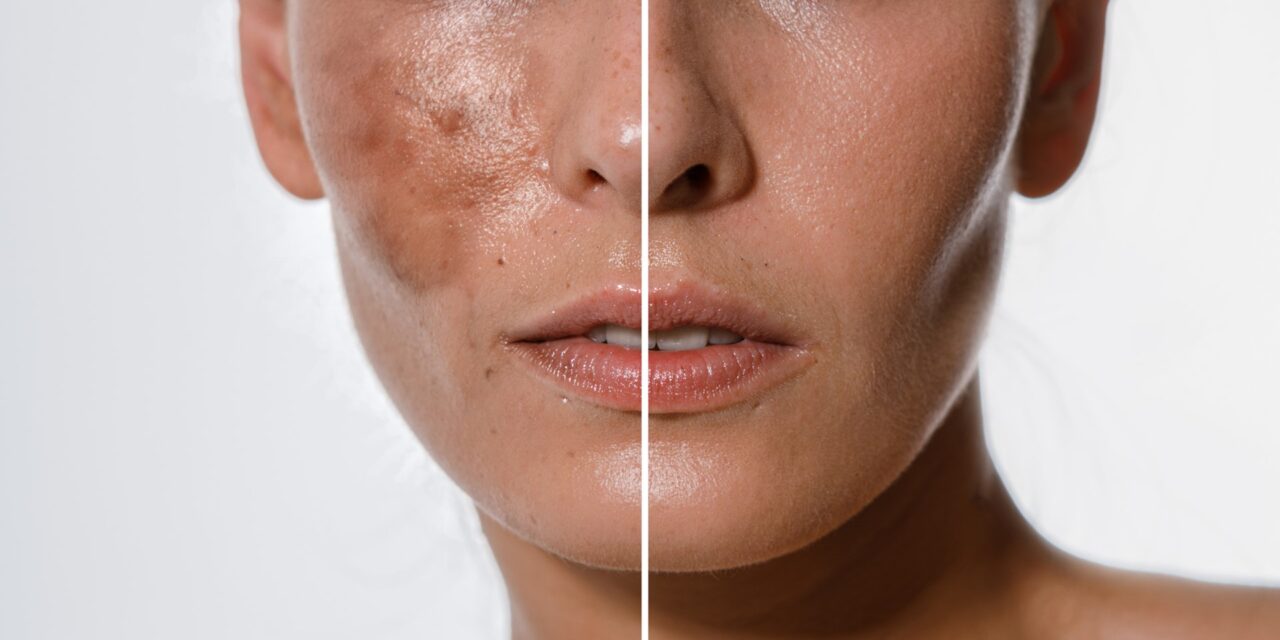 Hyperpigmentation – how to confirm the effectiveness of lightening cosmetics?